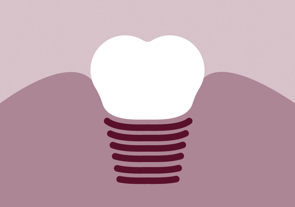 Implantologie Niederkassel | Sofort feste Zähne Niederkassel